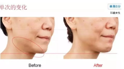 雅萌射頻美容儀防水嗎？雅萌Bloom射頻美容儀可以水洗嗎