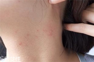 脖子上長(zhǎng)痘痘怎么辦 脖子上長(zhǎng)痘痘是什么原因