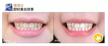 佳潔士一天美白牙貼真的能美白嗎 佳潔士美白牙貼評測 佳潔士一天美白牙貼真的能美白嗎 佳潔士美白牙貼評測