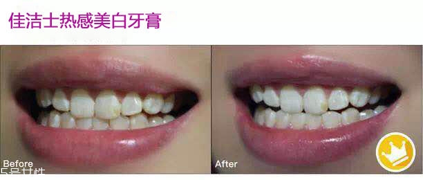 佳潔士熱感美白牙膏真的美白嗎 佳潔士美白牙膏真人試用 佳潔士熱感美白牙膏真的美白嗎 佳潔士美白牙膏真人試用