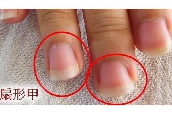 扇形甲怎么修復(fù) 扇形甲修復(fù)方法 扇形甲怎么修復(fù) 扇形甲修復(fù)方法