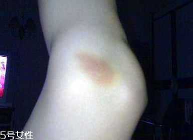 小林制藥去淤青膏怎么樣？小林制藥去淤青膏好用嗎？