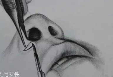 鼻翼外切多久消腫？鼻翼外切消腫時(shí)間要多長(zhǎng)？