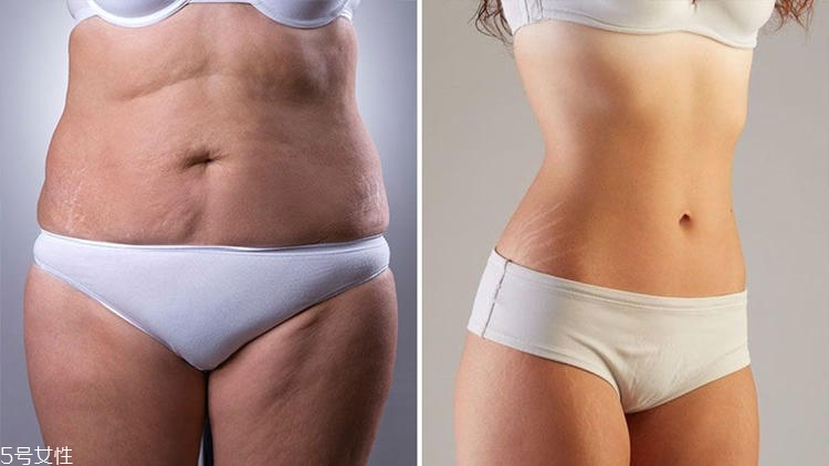 減肥后橘皮紋會消失嗎 夏季橘皮紋誤區(qū) 減肥后橘皮紋會消失嗎 夏季橘皮紋誤區(qū)
