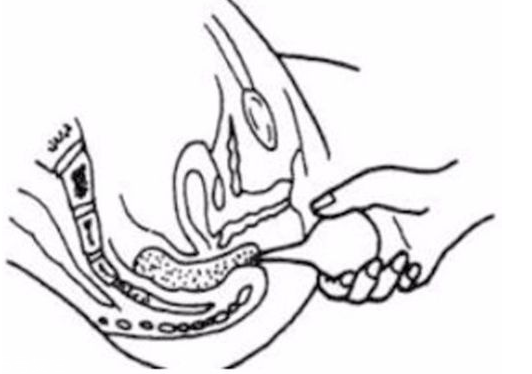 開(kāi)塞露躺著還是蹲著用？開(kāi)塞露使用姿勢(shì)