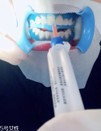 冷光美白會反彈嗎？冷光美白心得