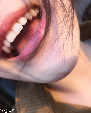 超聲波潔牙牙齒會變白嗎？超聲波潔牙心得