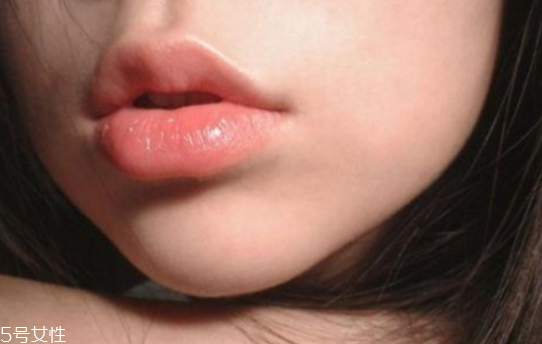 玻尿酸豐唇效果如何 玻尿酸豐唇后注意事項 玻尿酸豐唇效果如何 玻尿酸豐唇后注意事項