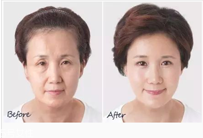 玻尿酸隆鼻怎么樣 玻尿酸隆鼻有什么優(yōu)勢(shì) 玻尿酸隆鼻怎么樣 玻尿酸隆鼻有什么優(yōu)勢(shì)