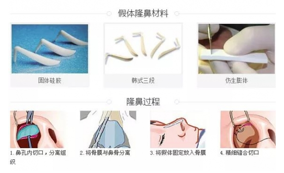 鼻子整形有幾種方法 鼻子整形哪種方法最好 鼻子整形有幾種方法 鼻子整形哪種方法最好