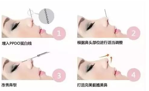 鼻子整形有幾種方法 鼻子整形哪種方法最好 鼻子整形有幾種方法 鼻子整形哪種方法最好