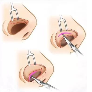 鼻假體取出后會增生嗎 鼻假體取出后會留疤嗎 鼻假體取出后會增生嗎 鼻假體取出后會留疤嗎