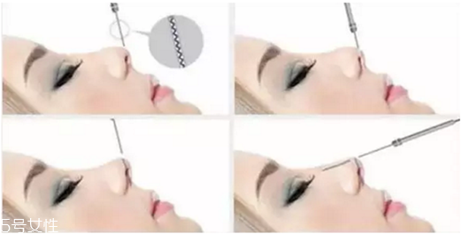 線雕隆鼻需要幾根線 線雕隆鼻安全嗎 線雕隆鼻需要幾根線 線雕隆鼻安全嗎