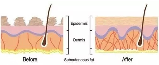 線雕提升能維持多久 線雕技術優(yōu)勢 線雕提升能維持多久 線雕技術優(yōu)勢