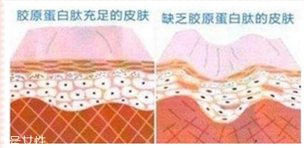 自體脂肪填充后吃什么好 自體脂肪填充后應(yīng)該注意什么 自體脂肪填充后吃什么好 自體脂肪填充后應(yīng)該注意什么