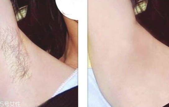 超冰脫毛跟冰點(diǎn)脫毛的區(qū)別在哪里 超冰和冰點(diǎn)脫毛的區(qū)別 超冰脫毛跟冰點(diǎn)脫毛的區(qū)別在哪里 超冰和冰點(diǎn)脫毛的區(qū)別