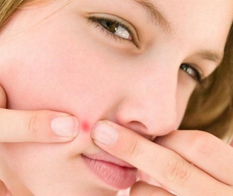 臉不同部位長痘痘的原因 臉上各部位長痘原因 臉不同部位長痘痘的原因 臉上各部位長痘原因