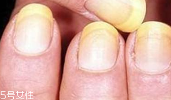 指甲變黃怎么調理 指甲變黃的治療方法 指甲變黃怎么調理 指甲變黃的治療方法