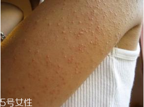 雞皮膚是怎么形成的 雞皮膚怎么根除 雞皮膚是怎么形成的 雞皮膚怎么根除