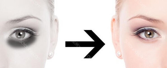 激光去黑眼圈多久恢復？激光除黑眼圈多久見效