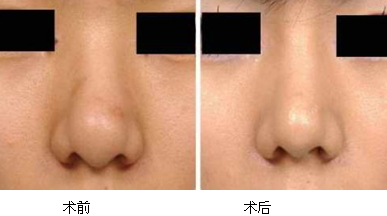 縮鼻手術(shù)多久恢復？縮鼻手術(shù)傷口才會好