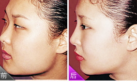 腫眼泡吸脂多少錢(qián)？腫眼泡吸脂做幾次