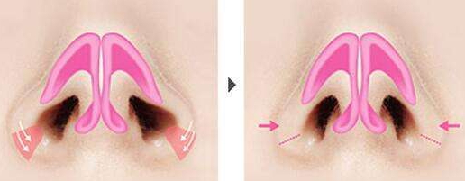 鼻孔縮小術(shù)術(shù)前注意事項 鼻孔縮小術(shù)后注意事項 鼻孔縮小術(shù)術(shù)前注意事項 鼻孔縮小術(shù)后注意事項
