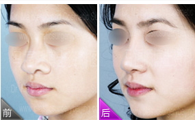 歪鼻矯正后遺癥 歪鼻矯正的危害 歪鼻矯正后遺癥 歪鼻矯正的危害