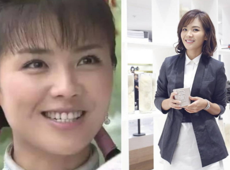 牙齒矯正會改變臉型嗎？矯正牙齒臉型變化圖