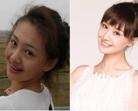 牙齒矯正會改變臉型嗎？矯正牙齒臉型變化圖