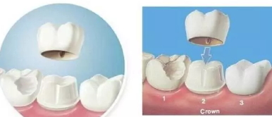 美容冠多少錢(qián)一顆？美容冠矯正費(fèi)用