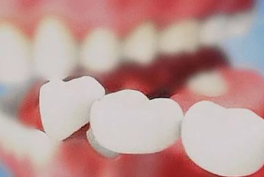 美容冠多少錢(qián)一顆？美容冠矯正費(fèi)用