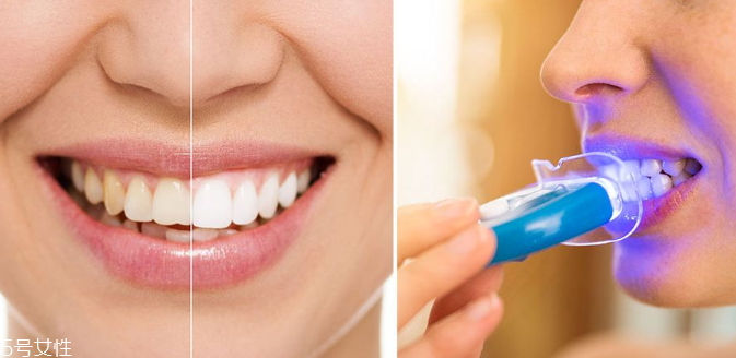 牙齒美白能保持多久？牙齒美白方法有哪些？