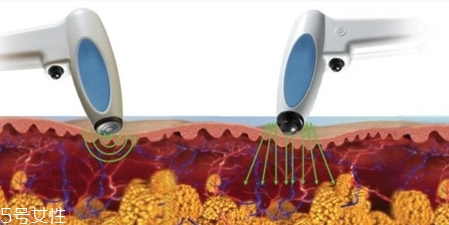 射頻溶脂效果怎么樣？射頻溶脂風(fēng)險(xiǎn)大嗎