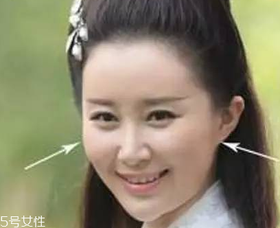 顴骨墊高能維持多久 顴骨墊高效果能永久嗎 顴骨墊高能維持多久 顴骨墊高效果能永久嗎