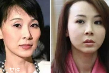 顴骨墊高能維持多久 顴骨墊高效果能永久嗎 顴骨墊高能維持多久 顴骨墊高效果能永久嗎