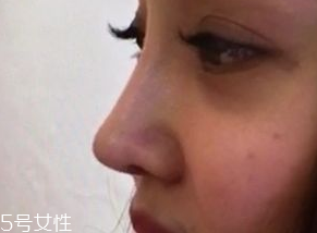 墊鼻尖后多久能做運(yùn)動(dòng) 墊鼻尖后做運(yùn)動(dòng)要注意什么 墊鼻尖后多久能做運(yùn)動(dòng) 墊鼻尖后做運(yùn)動(dòng)要注意什么