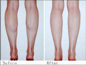 瘦小腿手術(shù)能維持多久 瘦小腿手術(shù)效果的影響因素 瘦小腿手術(shù)能維持多久 瘦小腿手術(shù)效果的影響因素