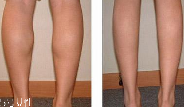 瘦小腿手術(shù)能維持多久 瘦小腿手術(shù)效果的影響因素 瘦小腿手術(shù)能維持多久 瘦小腿手術(shù)效果的影響因素