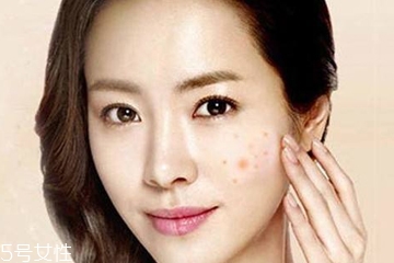 祛痘手術(shù)需要多少錢 祛痘手術(shù)費(fèi)用很高嗎 祛痘手術(shù)需要多少錢 祛痘手術(shù)費(fèi)用很高嗎