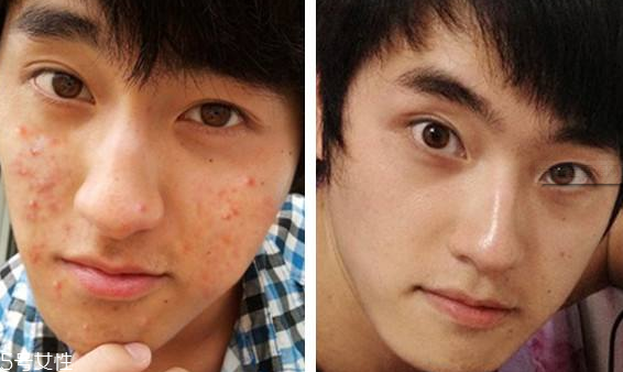 祛痘手術(shù)需要多少錢 祛痘手術(shù)費(fèi)用很高嗎 祛痘手術(shù)需要多少錢 祛痘手術(shù)費(fèi)用很高嗎