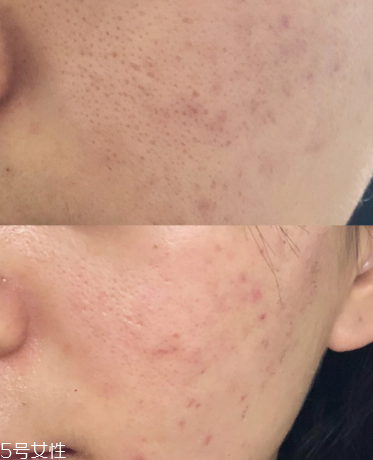 祛痘手術(shù)會(huì)反彈嗎 祛痘手術(shù)效果能永久嗎 祛痘手術(shù)會(huì)反彈嗎 祛痘手術(shù)效果能永久嗎