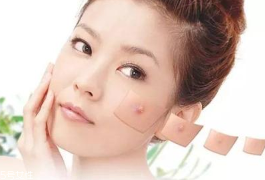 祛痘手術(shù)會(huì)反彈嗎 祛痘手術(shù)效果能永久嗎 祛痘手術(shù)會(huì)反彈嗎 祛痘手術(shù)效果能永久嗎