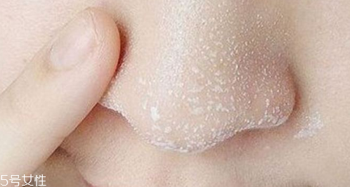 黑頭不管它會變大嗎？黑頭不管它會怎樣？