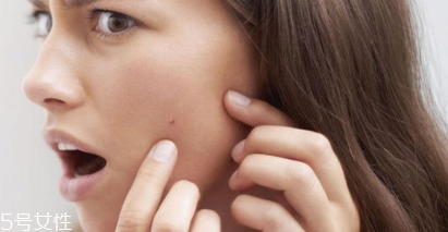 頑固痘痘怎么消除？油皮為什么反復爆痘？