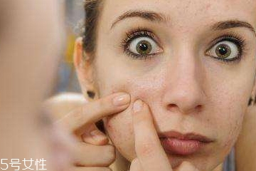 頑固痘痘怎么消除？油皮為什么反復爆痘？