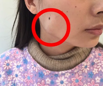 瘦臉針蛙腮怎么回事 瘦臉針蛙腮怎么處理 瘦臉針蛙腮怎么回事 瘦臉針蛙腮怎么處理