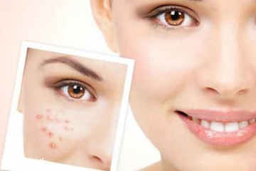 長痘痘用什么精油好 還你光滑白凈的肌膚 長痘痘用什么精油好 還你光滑白凈的肌膚