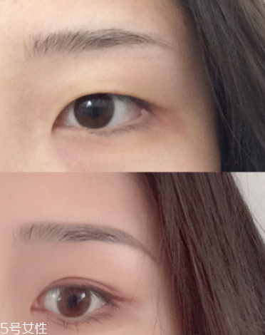 雙眼皮貼可以用什么代替 雙眼皮貼可以用什么代替