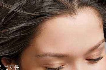 發(fā)際線后移怎么辦 這樣改善 發(fā)際線后移怎么辦 這樣改善